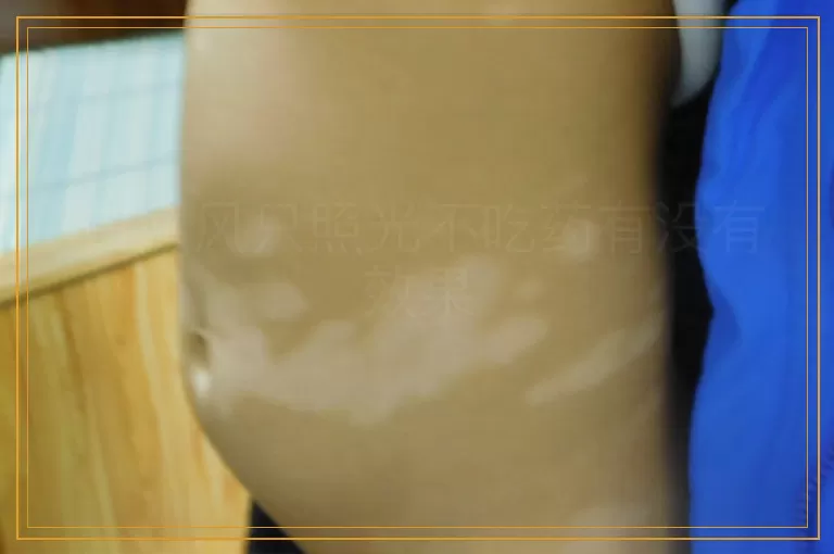 白癜风只照光不吃药有没有效果