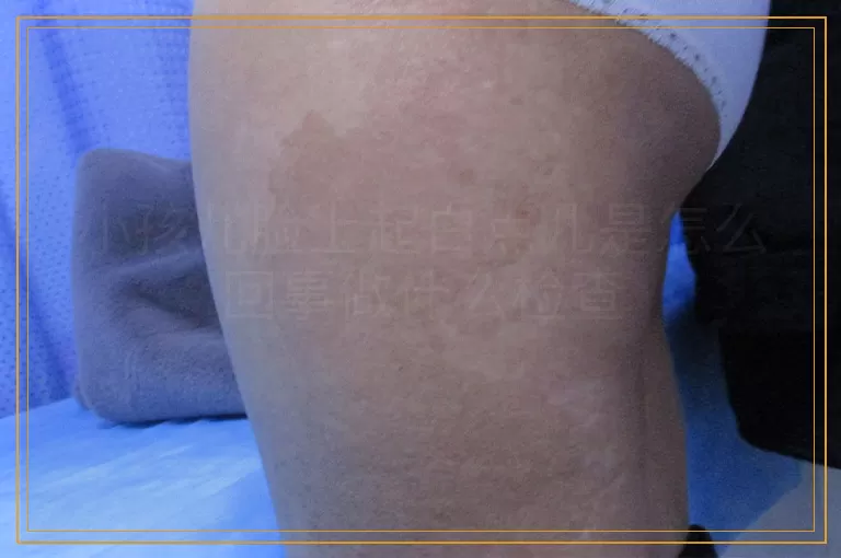 小孩儿脸上起白点儿是怎么回事做什么检查