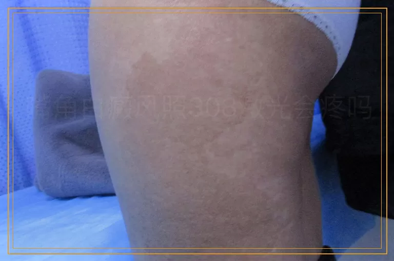 嘴角白癜风照308激光会疼吗