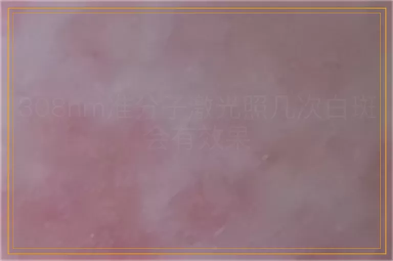 308nm准分子激光照几次白斑会有效果