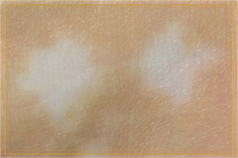手指上一个小白点是白癜风吗