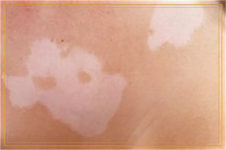 皮肤ct检查黑色素缺失是不是白癜风