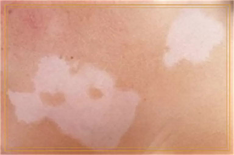 额头长了一大片小白点是怎么回事