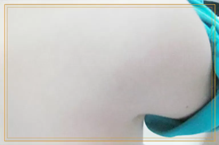 伍德灯检查白癜风症状对照表