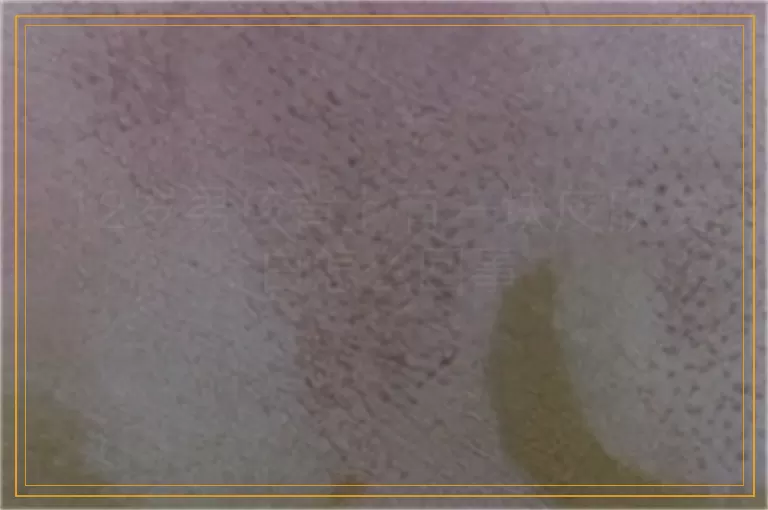 12岁男孩背上有一块皮肤发白怎么回事