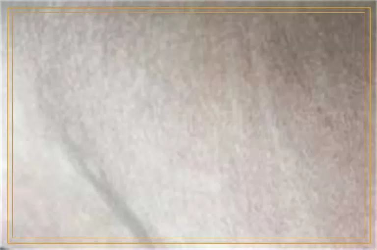 宝宝脸上有白斑是什么原因