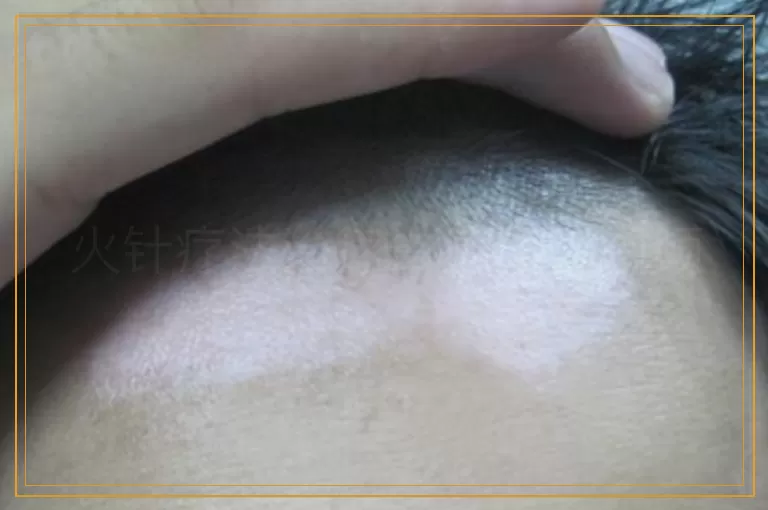 火针疗法治疗白癜风的视频