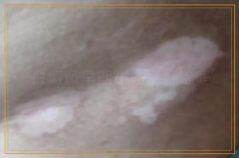 白癜风早期小白点好治吗