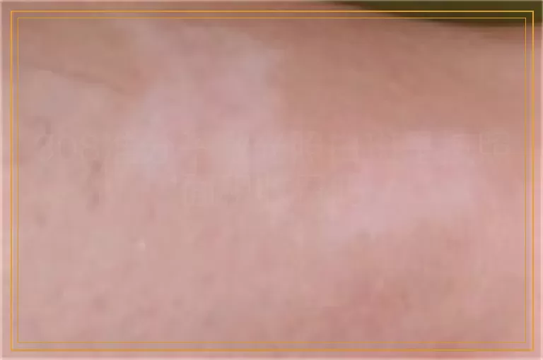 308准分子激光照白斑是按照面积收费吗