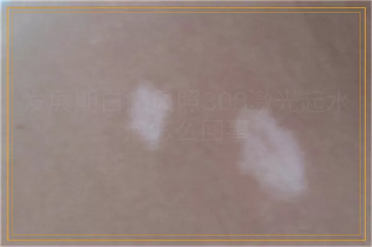 发展期白癜风照308激光起水泡怎么回事