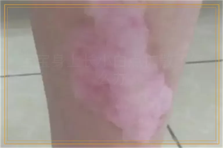 宝宝身上长小白点扩散了怎么办