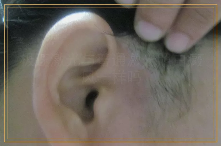 极速激光与普通激光照白癜风一样吗