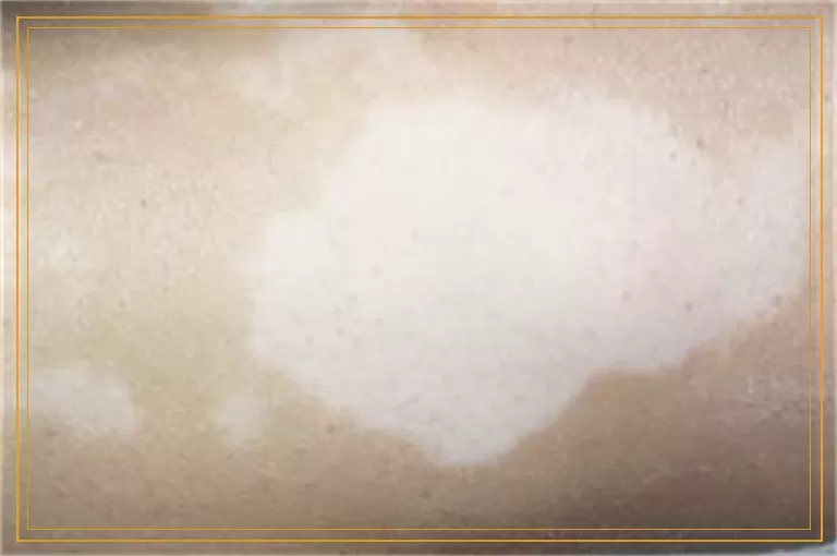 男士嘴唇上长白癜风可以照308激光吗