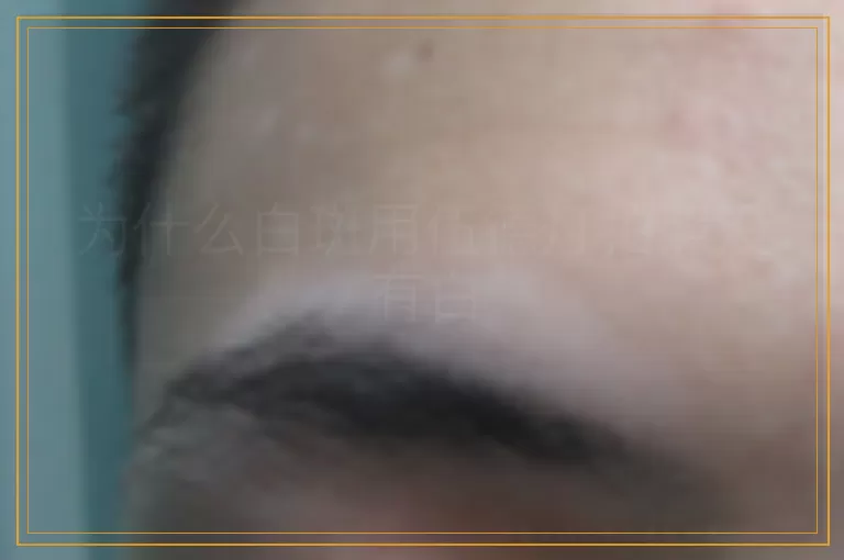 为什么白斑用伍德灯拍照没有白