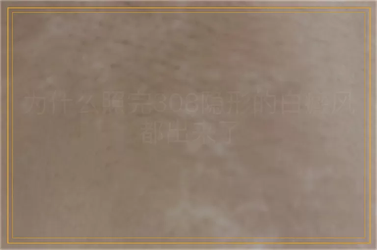 为什么照完308隐形的白癜风都出来了