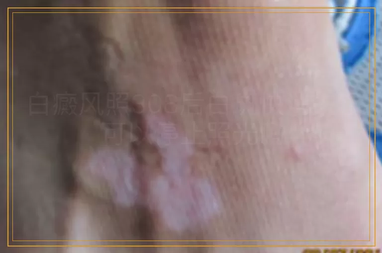 白癜风照308后白斑快消失了可以停止照光吗