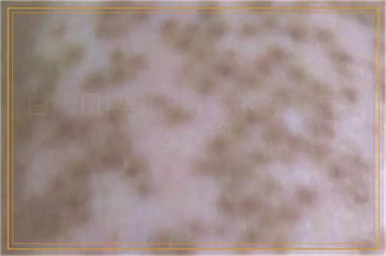 白癜风照308好转的过程有什么表现