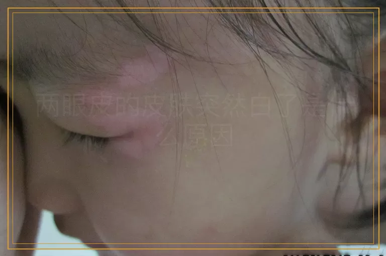 两眼皮的皮肤突然白了是什么原因