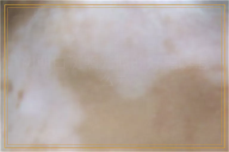 初期白斑照光照的好黑呀怎么办