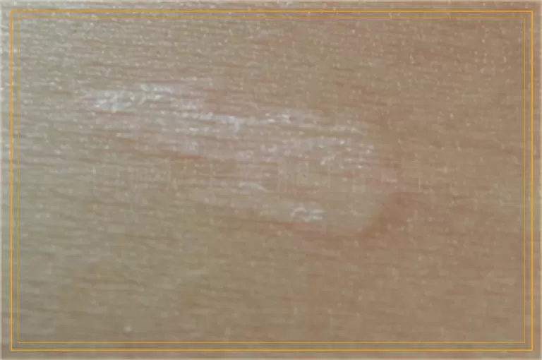 白癜风长在腿上的图片