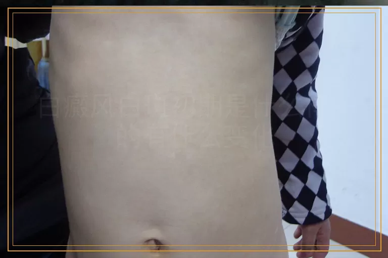 白癜风白斑初期是什么样子的有什么变化