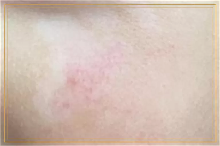 4岁孩子手臂白癜风是什么原因