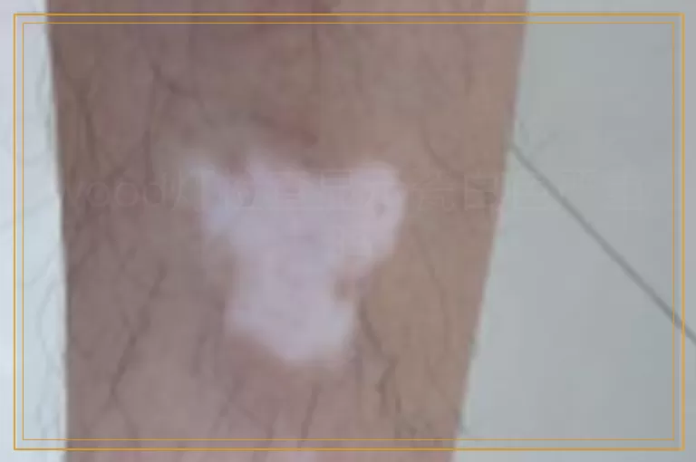 wood灯检查显示瓷白色严重吗