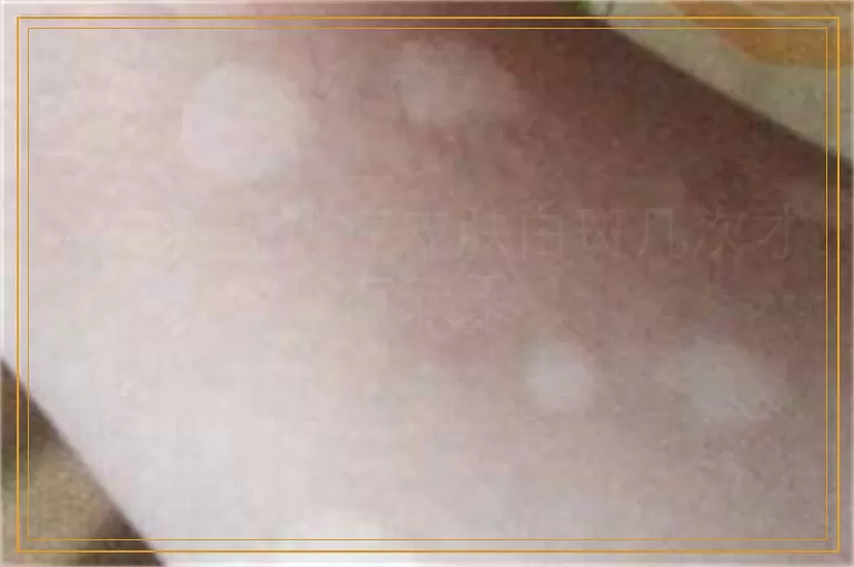 308激光治疗皮肤白斑几次才有效果