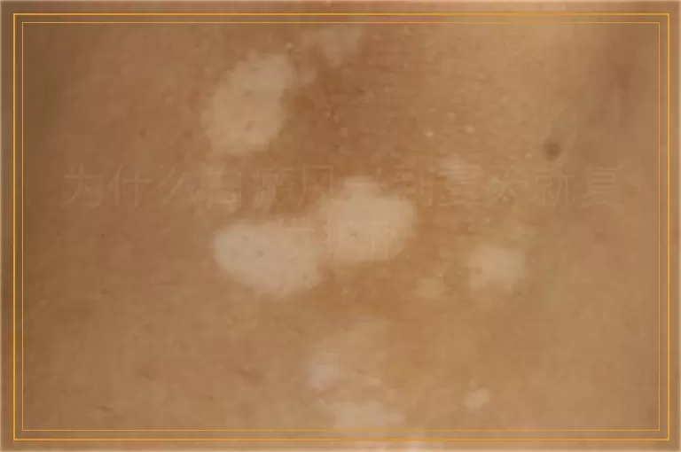 为什么白癜风一到夏天就复发扩散