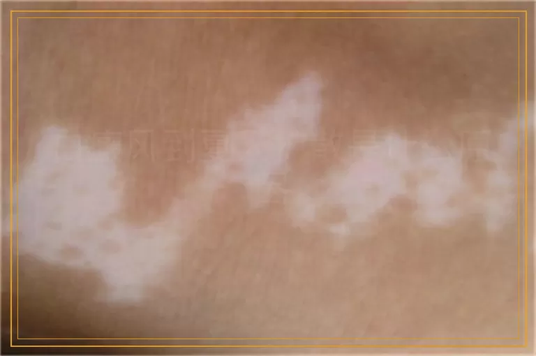 白癜风到夏天扩散是什么原因