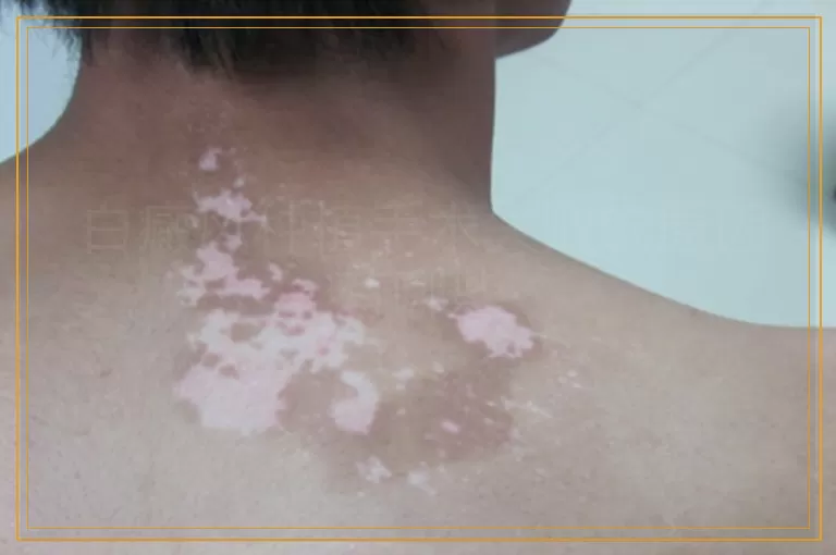 白癜风种植手术失败的原因有哪些