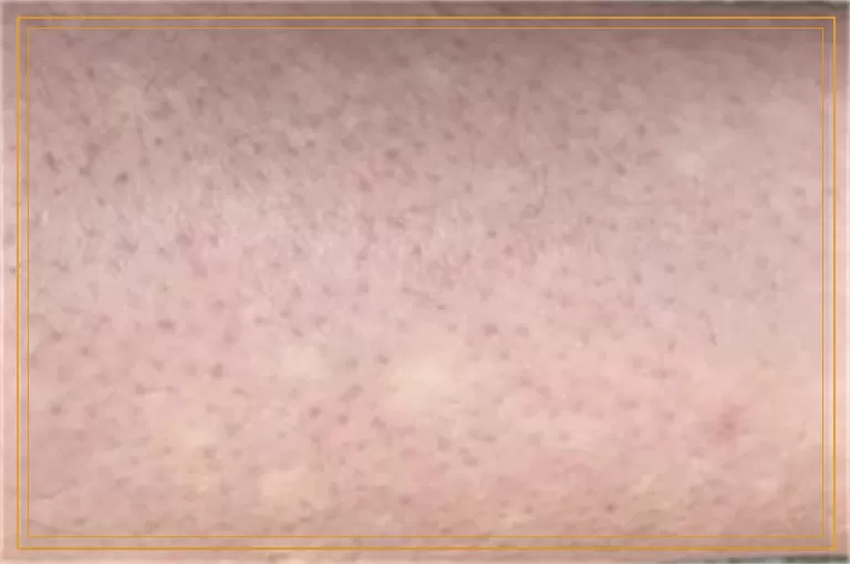 皮肤镜检查白斑大概需要多少钱