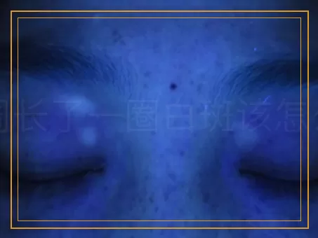 肛周长了一圈白斑该怎么治