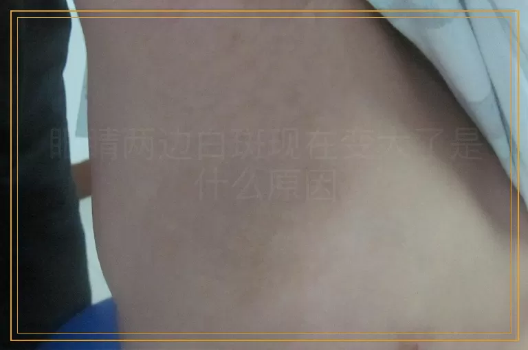 眼睛两边白斑现在变大了是什么原因