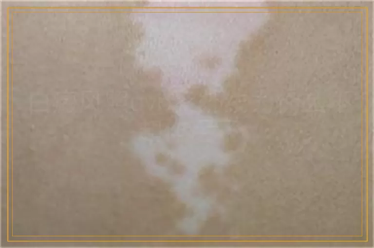 白癜风照uvb紫外线为什么不起作用了