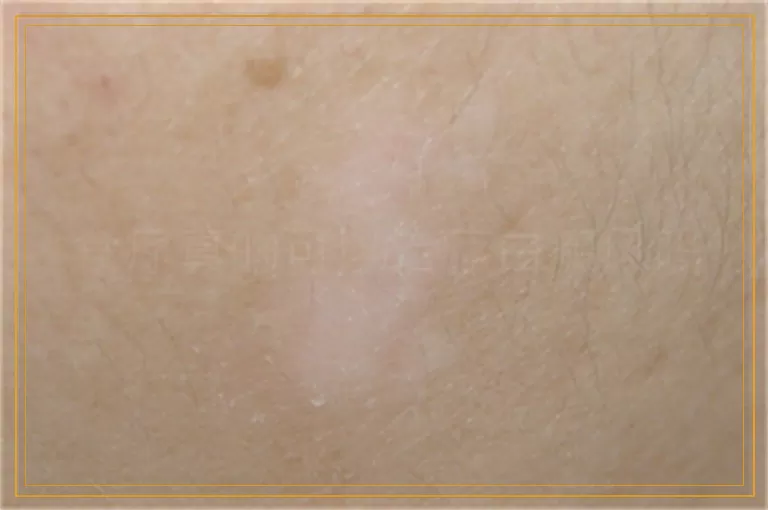 食疗真的可以治疗白癜风吗