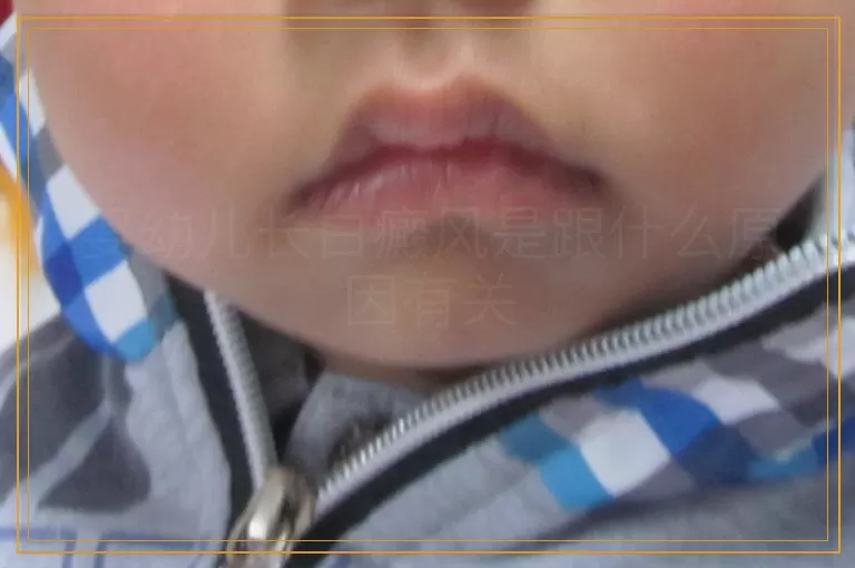 婴幼儿长白癜风是跟什么原因有关
