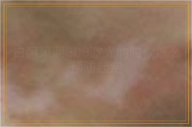 白癜风照308激光的时候怎么预防起泡