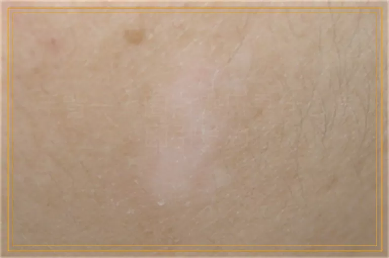 手背一大圈白癜风是什么原因引发的