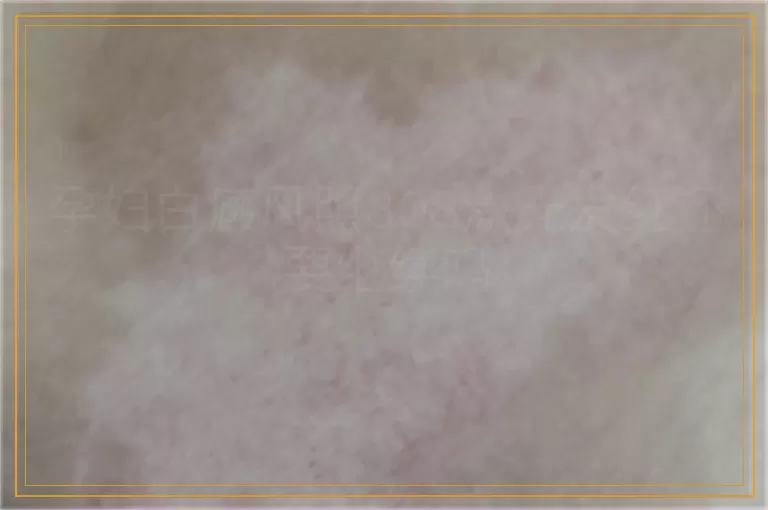 孕妇白癜风照308激光发红还要继续吗
