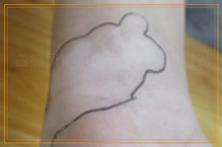 白癜风能不能天天照308激光