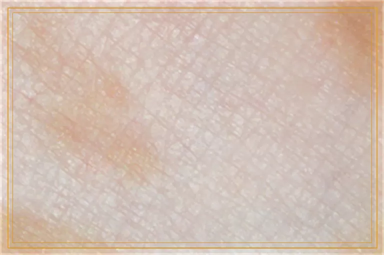 50岁女士脖子为什么长白癜风