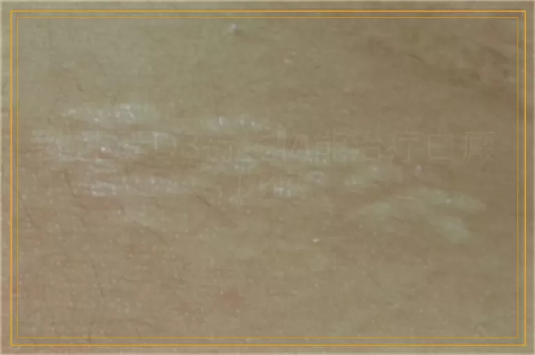 维生素D3衍生物能治疗白癜风吗