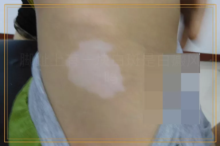 脚趾上有一块白斑是白癜风吗