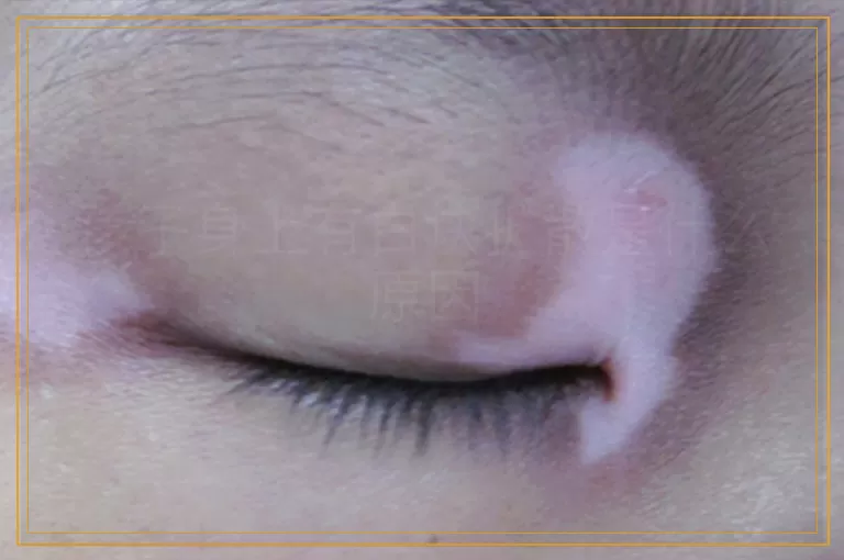 孩子身上有白块扩散是什么原因