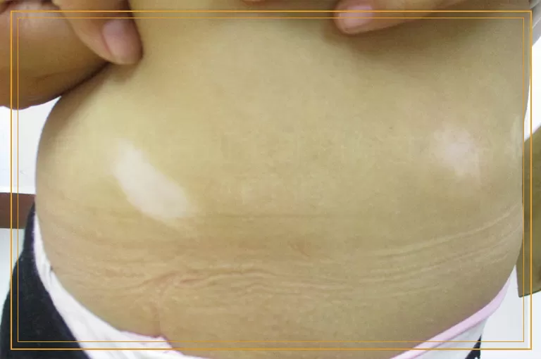 白癜风白斑全部祛除才算治好了吗