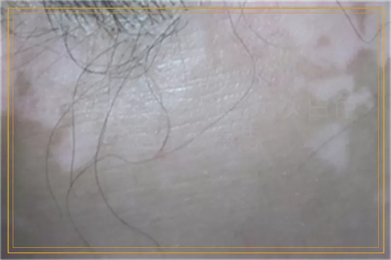 伍德灯检查白斑显示灰白色是什么意思