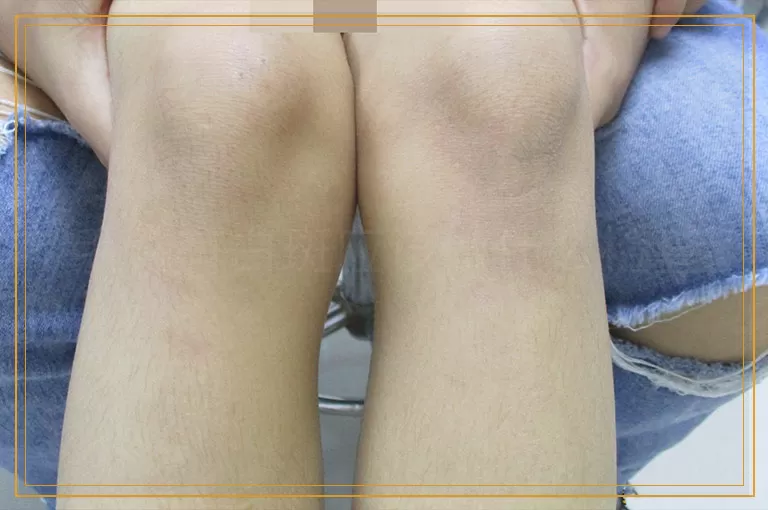 手臂有白斑应该做什么检查