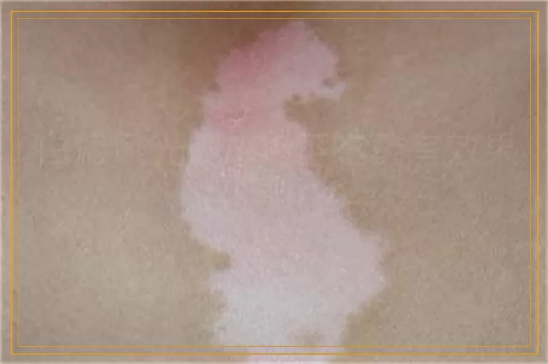 白癜风光照308不吃药有效果吗