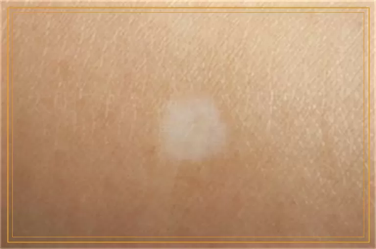 太阳穴的地方长白斑有2年了怎么治